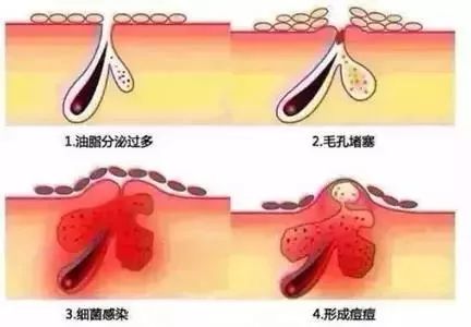 怎么才能更好的消除脸上的痘坑痘印